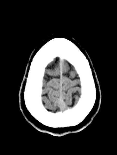 File:Cerebral venous angioma (Radiopaedia 69959-79977 Axial non-contrast 28).jpg