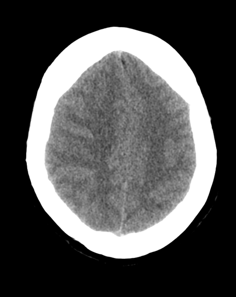 File:Cerebral venous infarct related to dural venous sinus thromboses (Radiopaedia 35292-36803 AXIAL THICK 21).png