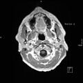 Cervical dural CSF leak on MRI and CT treated by blood patch (Radiopaedia 49748-54995 Axial T1 C+ 9).jpg