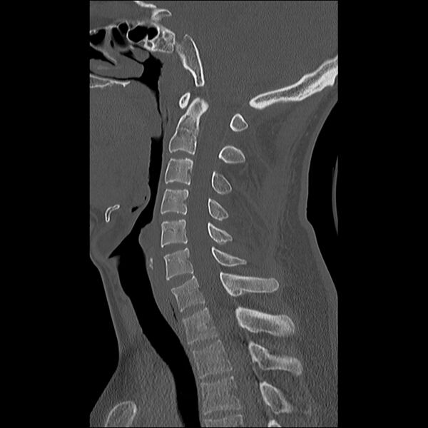 File:Cervical facet fracture and anterior discoligamentous injury (Radiopaedia 32139-33083 Sagittal bone window 18).jpg