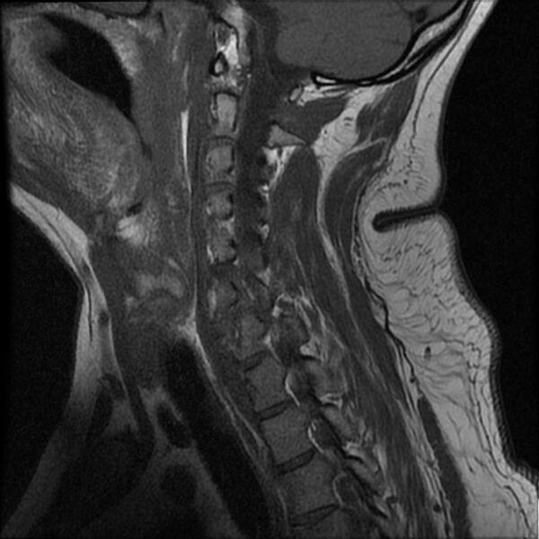 File:Cervical fracture and dislocation with locked facet (Radiopaedia 31837-32781 Sagittal T1 11).jpg