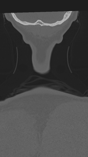 File:Cervical intercalary bone (Radiopaedia 35211-36748 Coronal bone window 84).png