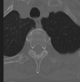 Cervical spondylolysis (Radiopaedia 49616-54811 Axial bone window 56).png