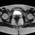 Cesarian section scar endometriosis (Radiopaedia 66520-75799 Axial T2 20).jpg