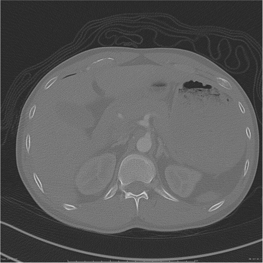 Chest and abdomen multi-trauma (Radiopaedia 26294-26425 bone window 107).jpg