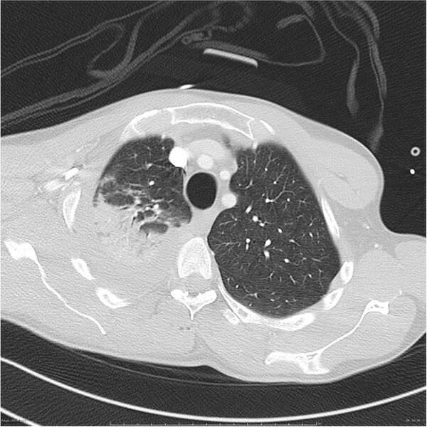 File:Chest and abdomen multi-trauma (Radiopaedia 26294-26425 lung window 30).jpg