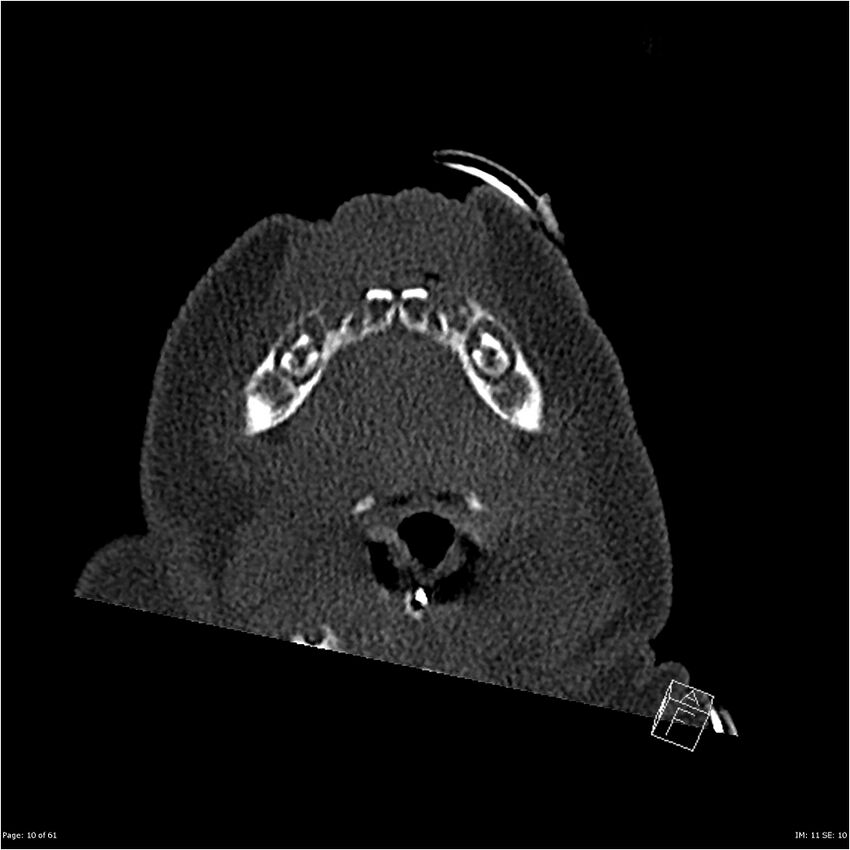 Choanal atresia (Radiopaedia 23492-23579 bone window 10).jpg