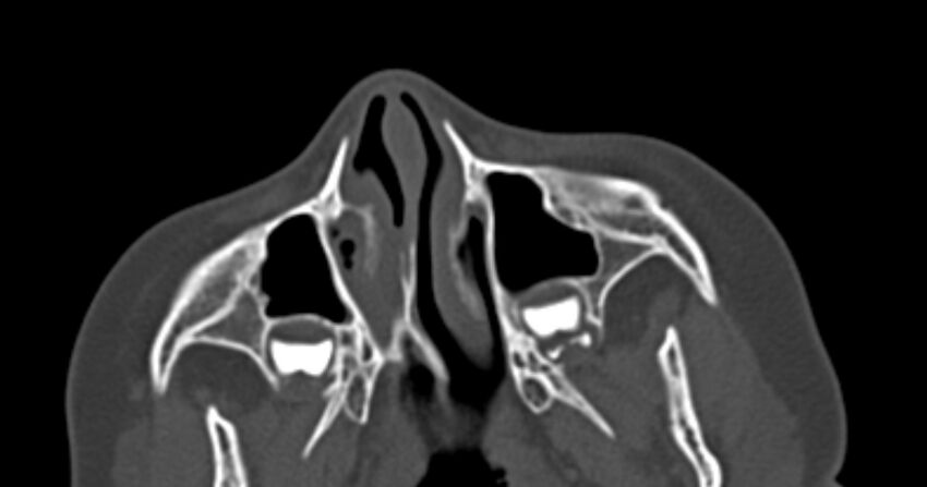 Choanal atresia (Radiopaedia 51295-56972 Axial bone window 17).jpg