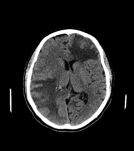 File:Cholangiocarcinoma with cerebral metastases (Radiopaedia 83519-98628 Axial non-contrast 37).jpg