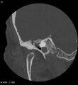 Cholesteatoma (Radiopaedia 5467-7197 Coronal bone window 3).jpg