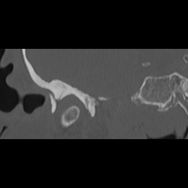 File:Cholesteatoma (Radiopaedia 68176-77673 Coronal bone window 12).jpg