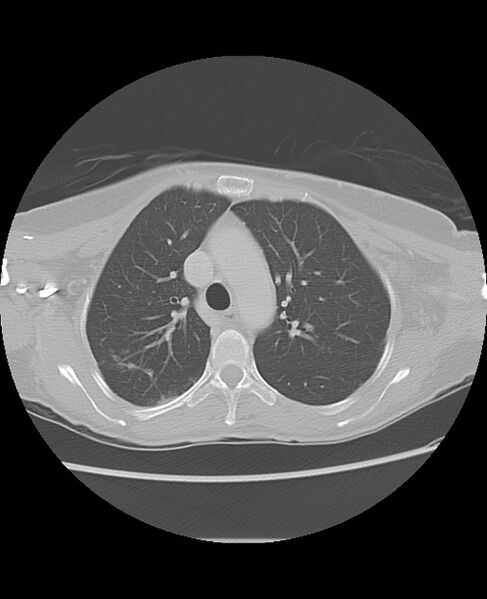 File:Chondrosarcoma (Radiopaedia 79427-92532 Axial lung window 18).jpg