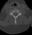 Chordoma (C4 vertebra) (Radiopaedia 47561-52188 Axial bone window 33).png
