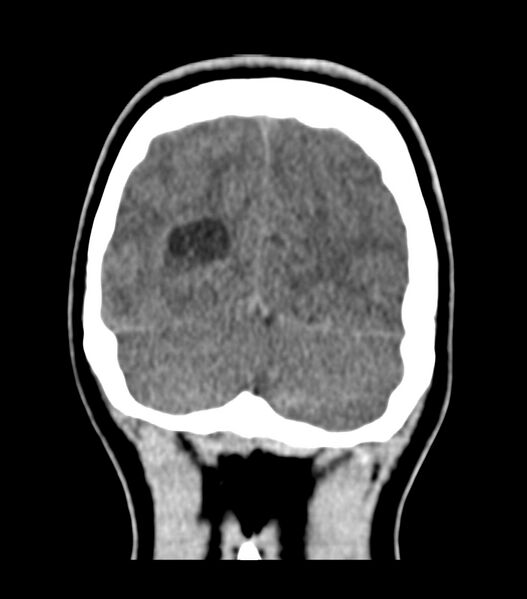 File:Choroid plexus carcinoma (Radiopaedia 91013-108552 Coronal non-contrast 74).jpg