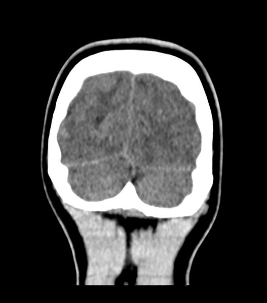 File:Choroid plexus carcinoma (Radiopaedia 91013-108552 Coronal non-contrast 77).jpg