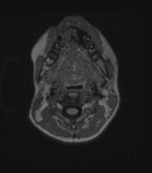 File:Choroid plexus carcinoma (Radiopaedia 91013-108553 Axial FLAIR C+ 33).jpg