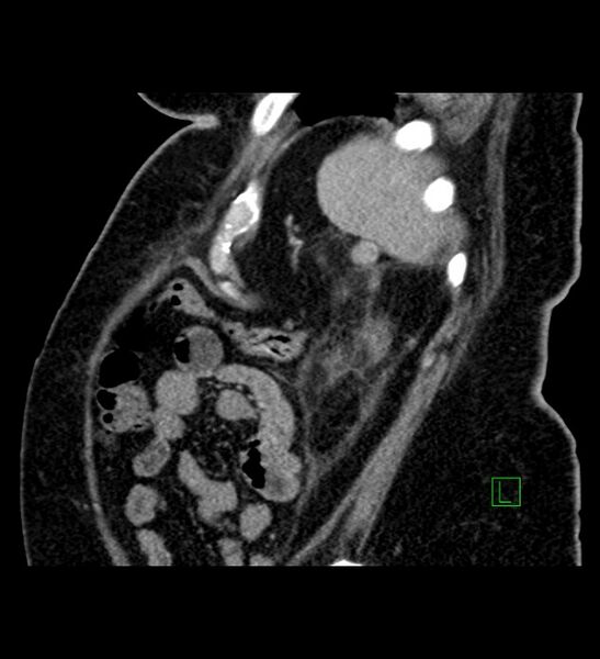 File:Chromophobe renal cell carcinoma (Radiopaedia 84239-99519 D 21).jpg