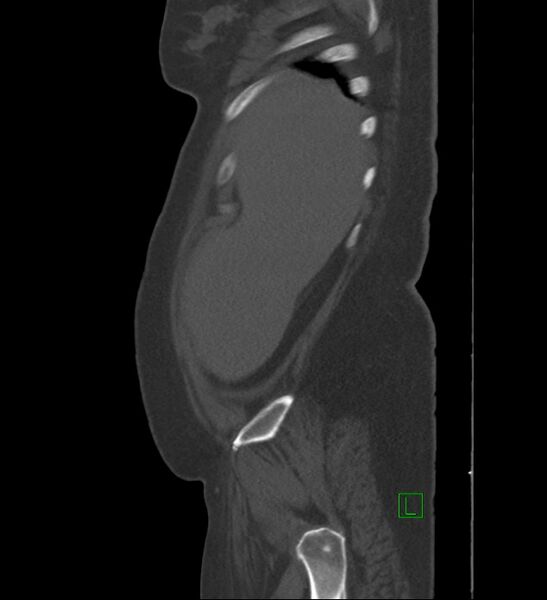 File:Chromophobe renal cell carcinoma (Radiopaedia 84239-99519 Sagittal bone window 95).jpg