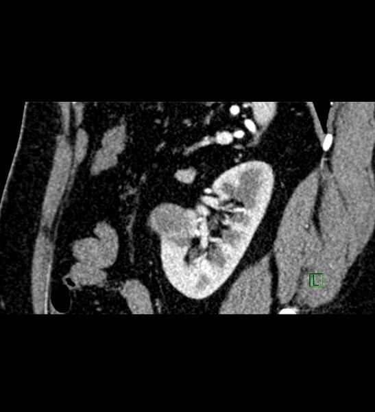 File:Chromophobe renal cell carcinoma (Radiopaedia 84286-99573 F 46).jpg
