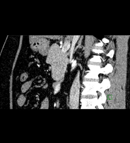 File:Chromophobe renal cell carcinoma (Radiopaedia 84286-99573 F 96).jpg