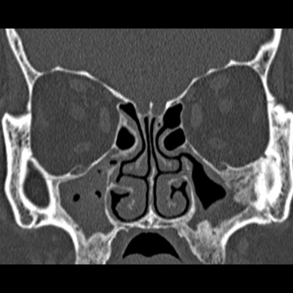 File:Chronic maxillary sinusitis (Radiopaedia 27879-28116 Coronal bone window 24).jpg