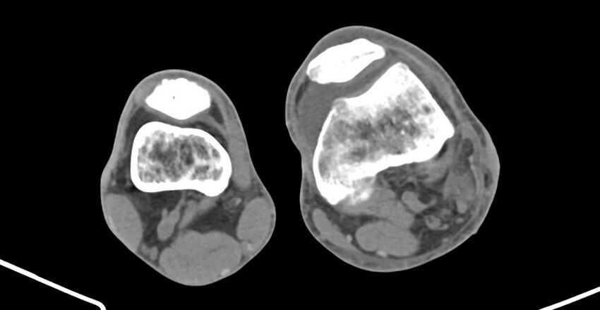 Chronic osteomyelitis (with sequestrum) (Radiopaedia 74813-85822 D 177).jpg