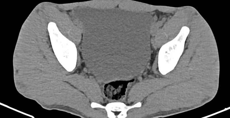 File:Chronic osteomyelitis (with sequestrum) (Radiopaedia 74813-85822 D 24).jpg