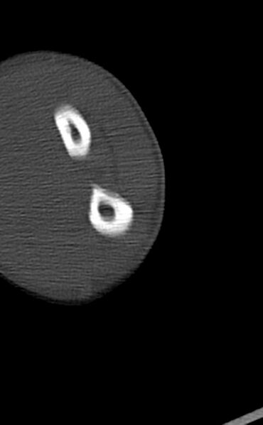 File:Chronic osteomyelitis of the distal humerus (Radiopaedia 78351-90971 Axial bone window 121).jpg