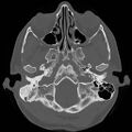 Chronic otomastoiditis (Radiopaedia 27138-27309 Axial bone window 11).jpg