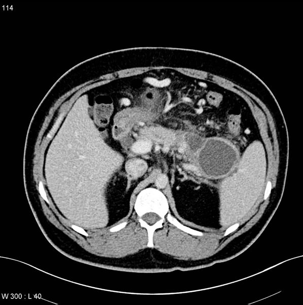 File:Chronic pancreatitis and pseudocysts (Radiopaedia 6724-7935 D 5).jpg
