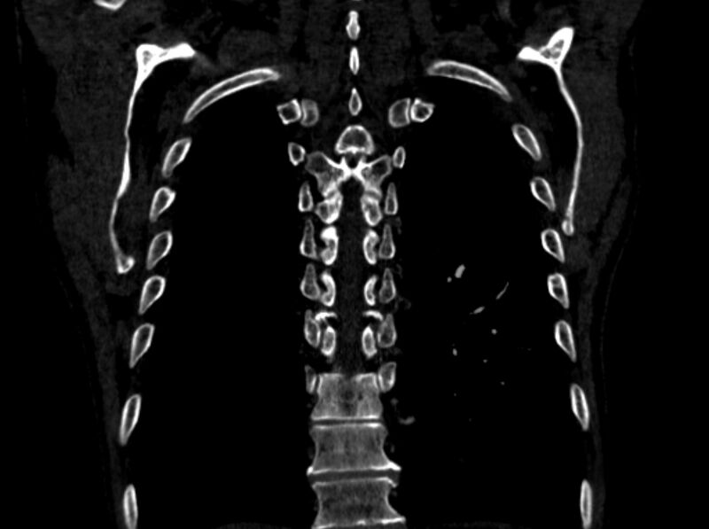 File:Chronic pulmonary embolism (Radiopaedia 91241-108843 A 94).jpg