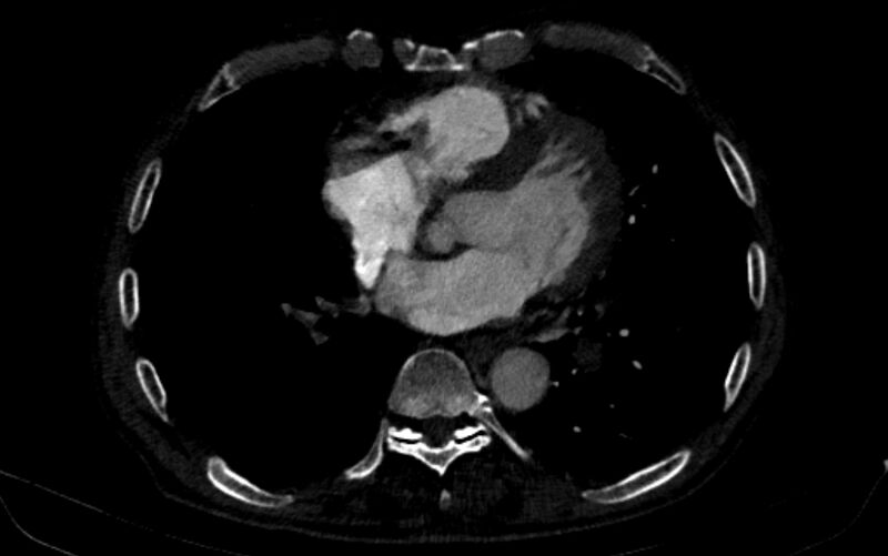 File:Chronic pulmonary embolism (Radiopaedia 91241-108843 B 122).jpg