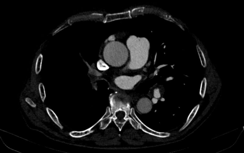 File:Chronic pulmonary embolism (Radiopaedia 91241-108843 B 96).jpg