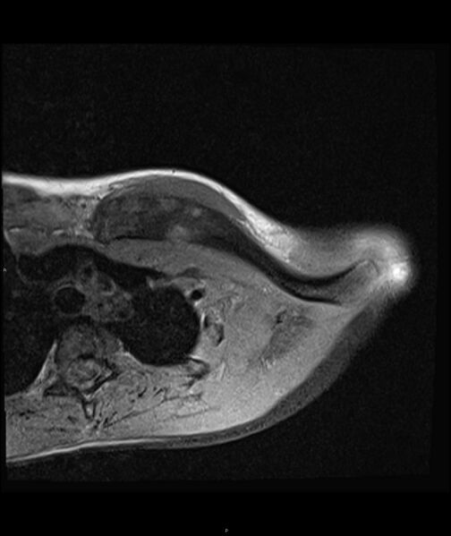File:Chronic reactive multifocal osteomyelitis (CRMO) - clavicle (Radiopaedia 56406-63071 Axial T1 fat sat 9).jpg