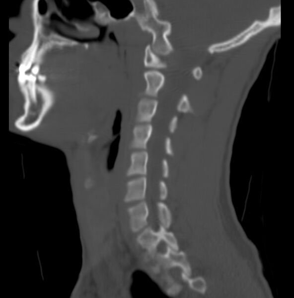 File:Cleft of the posterior arch of C1 mimicking fracture (Radiopaedia 40201-42721 Sagittal bone window 12).jpg