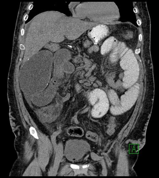 File:Closed-loop small bowel obstruction-internal hernia (Radiopaedia 78439-91096 Coronal non-contrast 43).jpg