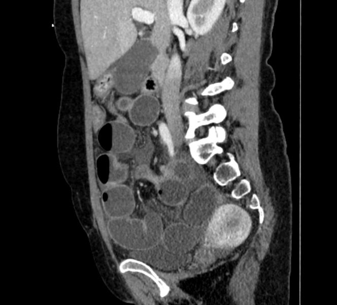 File:Closed loop small bowel obstruction (Radiopaedia 71211-81508 C 55).jpg
