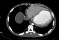 Coarctation of aorta with aortic valve stenosis (Radiopaedia 70463-80574 A 173).jpg