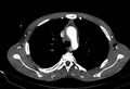 Coarctation of aorta with aortic valve stenosis (Radiopaedia 70463-80574 A 43).jpg