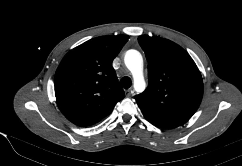 File:Coarctation of aorta with aortic valve stenosis (Radiopaedia 70463-80574 A 43).jpg