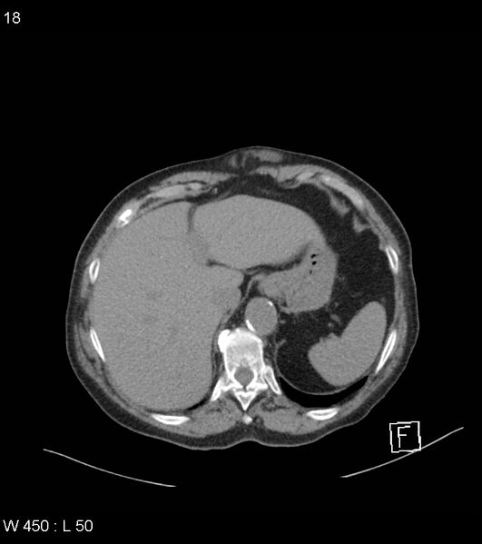 File:Colonic diverticular hemorrhage (Radiopaedia 52561-58475 Axial non-contrast 14).jpg