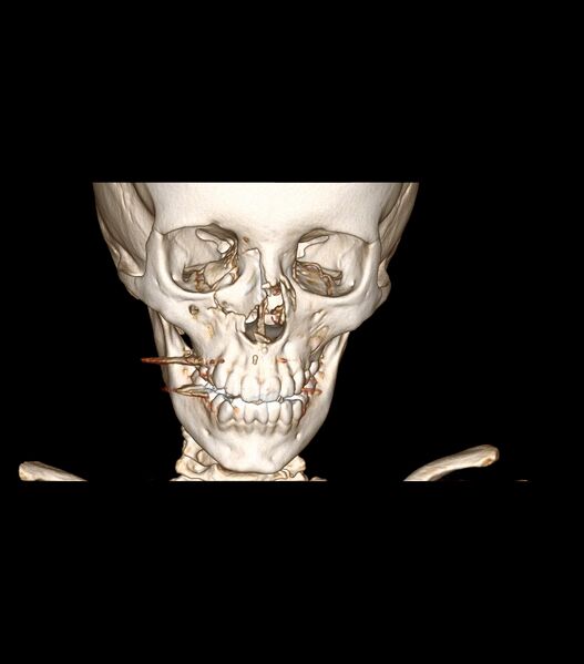 File:Nasoorbitoethmoid fracture (Radiopaedia 90044-107205 3D VRT 17).jpg