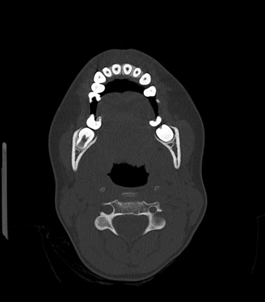 File:Nasoorbitoethmoid fracture (Radiopaedia 90044-107205 Axial bone window 38).jpg