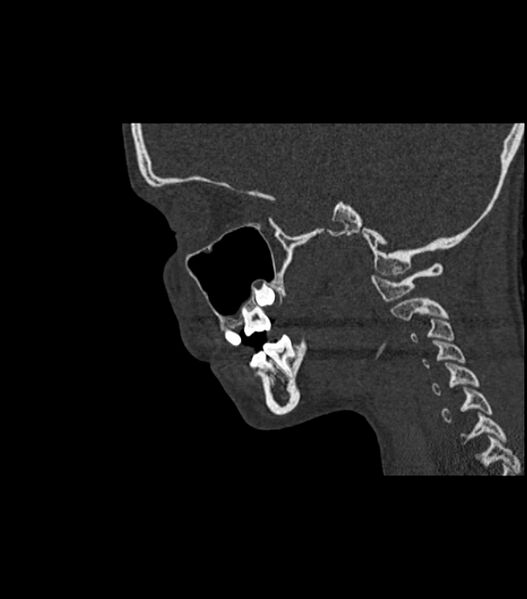 File:Nasoorbitoethmoid fracture (Radiopaedia 90044-107205 Sagittal bone window 56).jpg
