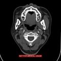 Nasopharyngeal carcinoma recurrence - skull base destruction (Radiopaedia 29107-29491 A 15).jpg