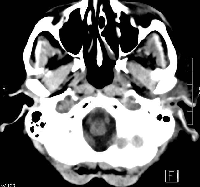 File:Necrotizing otitis externa (Radiopaedia 19938-19971 Axial non-contrast 4).jpg