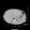 Neonatal neuroblastoma (Radiopaedia 56651-63438 Axial non-contrast 19).jpg