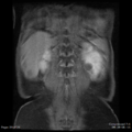 Nephroblastomatosis (Radiopaedia 39984-42478 D 1).png