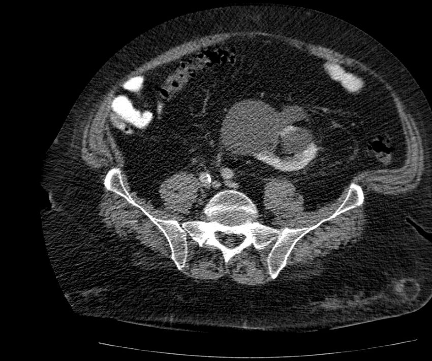 Nephroptosis with inguinal hernia containing perirenal fat (Radiopaedia 56632-63391 C 244).jpg