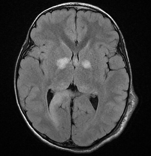File:Neurofibromatosis type 1 (Radiopaedia 6954-8063 Axial FLAIR 5).jpg